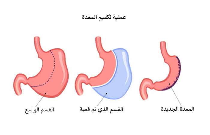 عملية التكميم | عملية قص المعدة | المخاطر والنصائح والاسعار