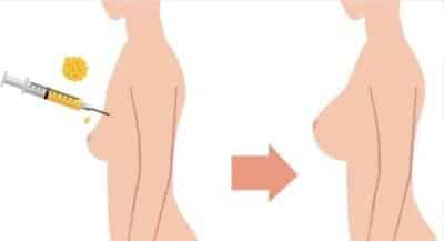 Breast Fat Transfer