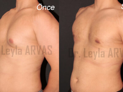 Gynecomastia Surgery