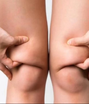 Knee Liposuction