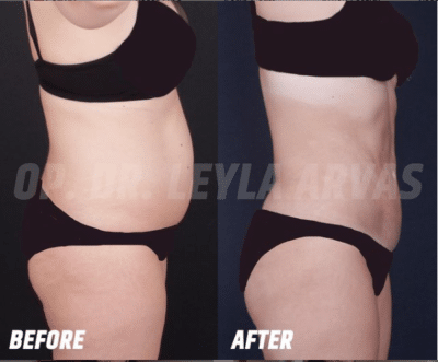 Liposuction (Fat Removal)