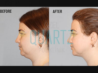 Double Chin Liposuction