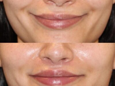 Lip lift