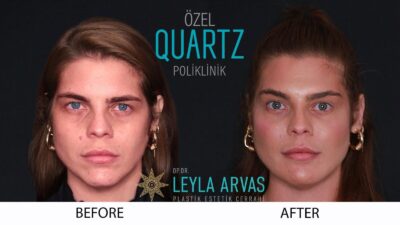 Liquid Face Lift