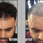 Fue Hair Transplant