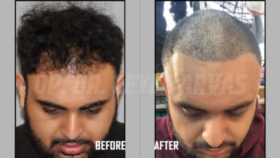 Fue Hair Transplant