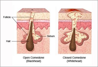 Comedone Treatment