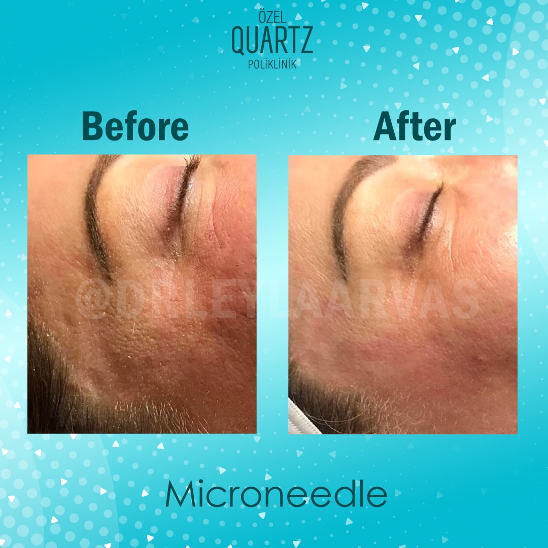 RF Microneedling