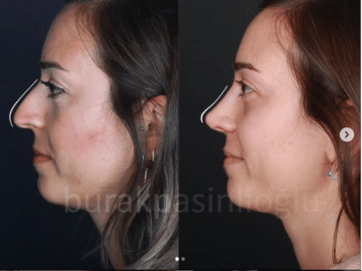 Nose Job Surgery