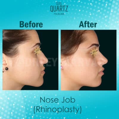 Nose Job Surgery