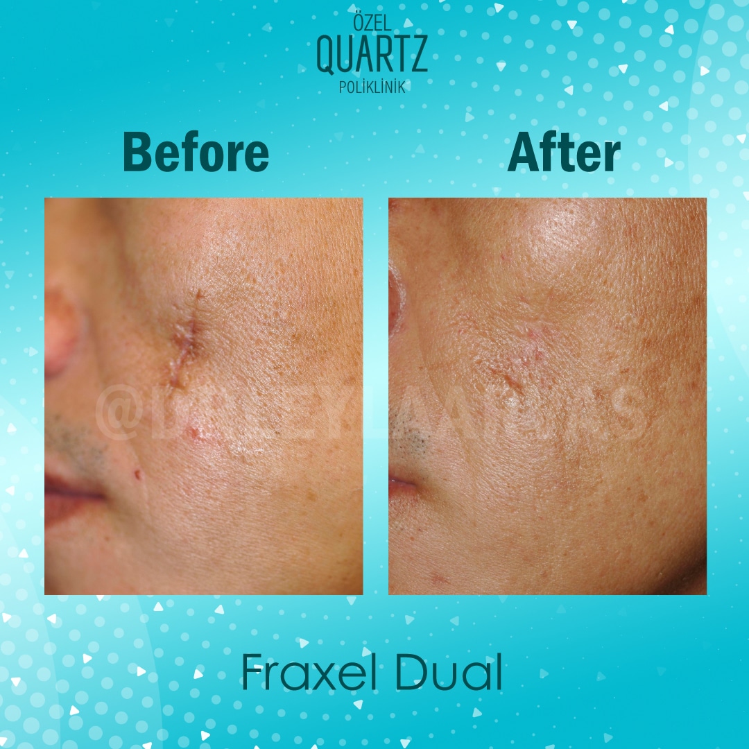 Fraxel Dual Laser