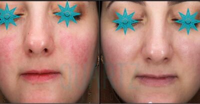 Rosacea Treatment