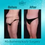 Tummy Tuck