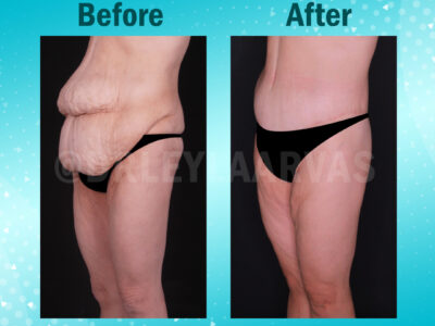 Tummy Tuck