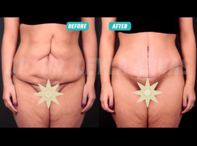 Tummy Tuck Recovery