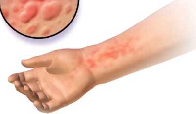 Hives (Urticaria)