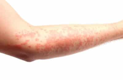 Hives (Urticaria)