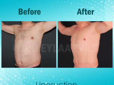 Vaser Liposuction