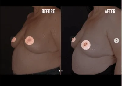 Inverted Nipple Surgery