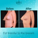 Breast Fat Transfer