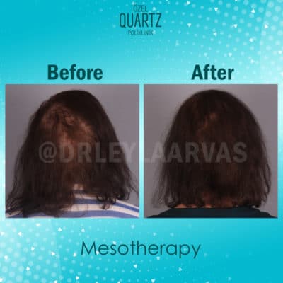 Mesotherapy