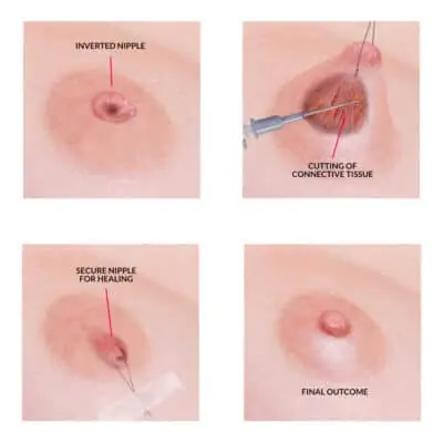 Inverted Nipple Surgery