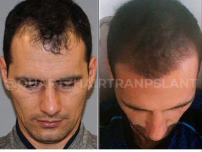 Hair Transplantation