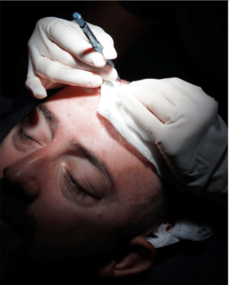 Fue Hair Transplant