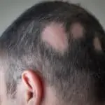 Ringworm Scalp Treatment