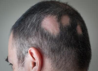 Ringworm Scalp Treatment