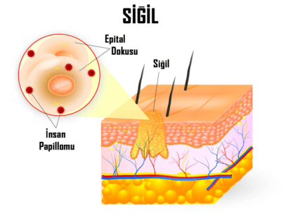 Wart Treatment