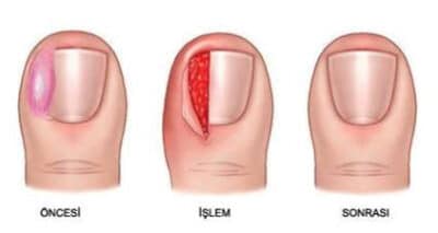 Ingrown Nail Treatment