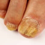 Nail Fungus