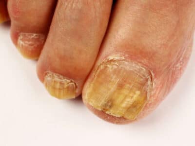 Nail Fungus