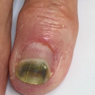 Nail Fungus