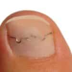 Ingrown Nail Treatment