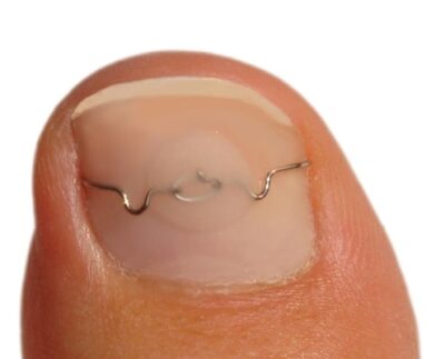 Ingrown Nail Treatment