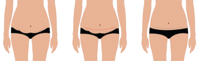 Tummy Tuck Scars