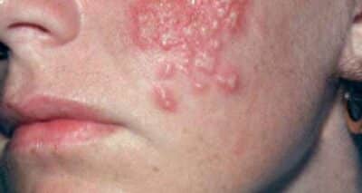 Herpes Treatment