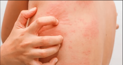 Hives (Urticaria)