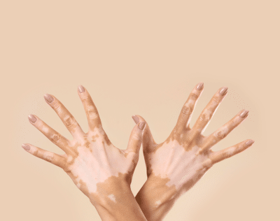 Vitiligo Treatment