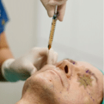 Facial Fat Transfer