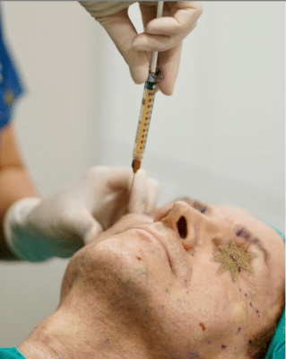 Facial Fat Transfer