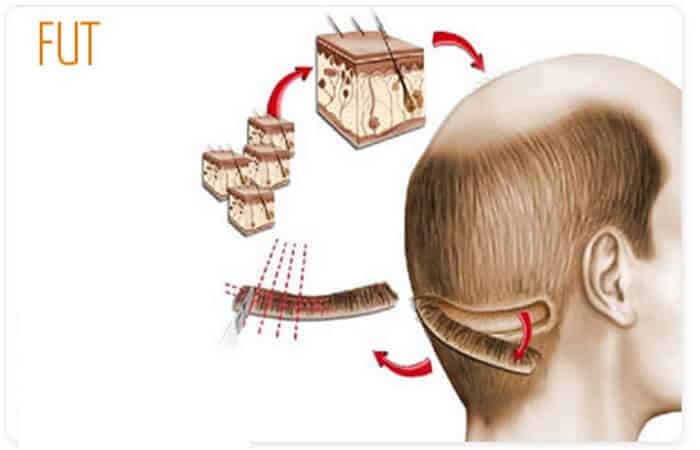 طريقة زراعة الشعر