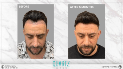 Haartransplantation