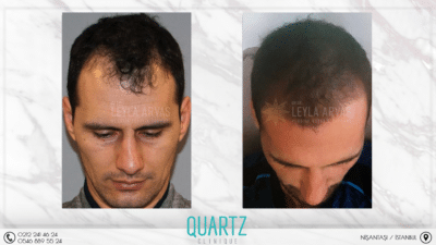 Haartransplantation