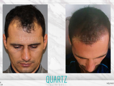 Haartransplantation