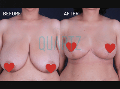 Breast Reduction Surgery