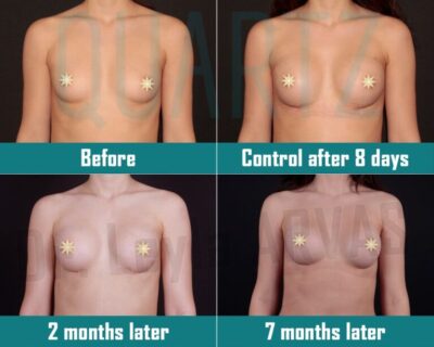 Breast Augmentation 