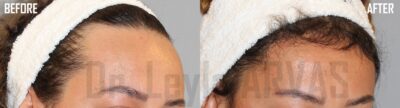 Haartransplantation bei Frauen